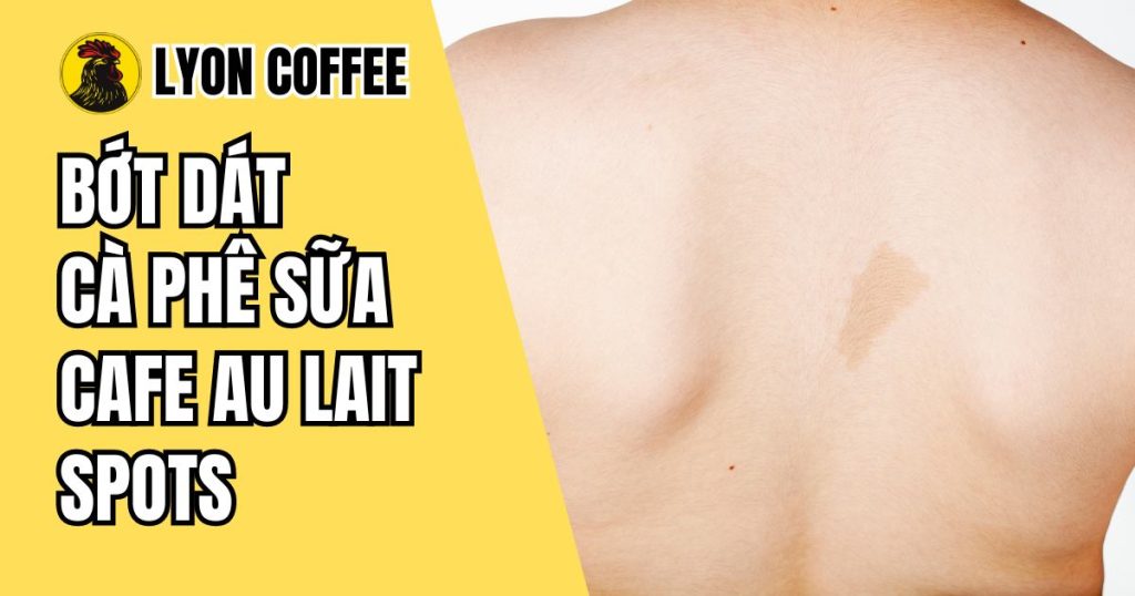 Bớt dát cà phê sữa Cafe Au Lait Spots