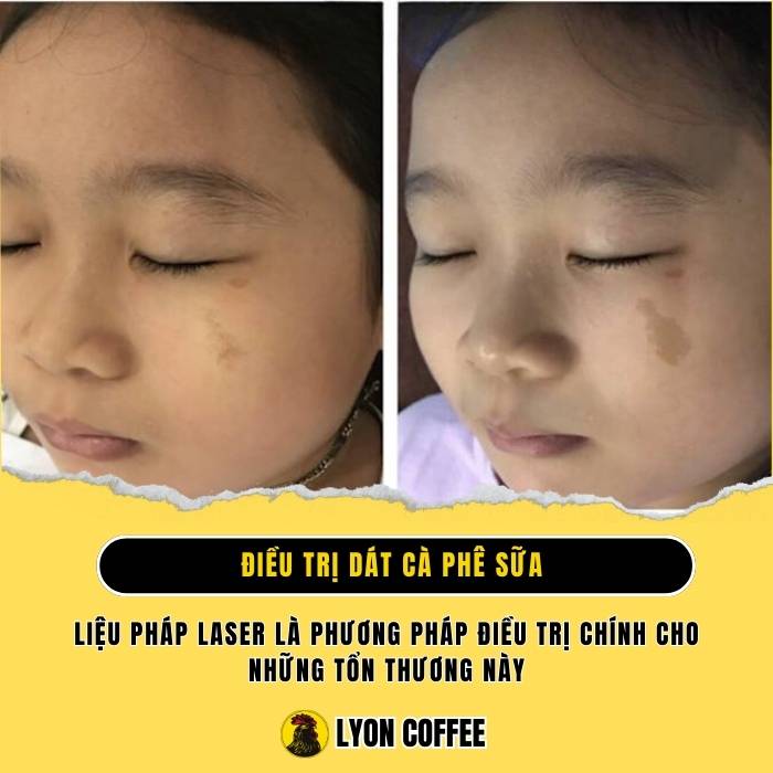 Bớt dát cà phê sữa Cafe Au Lait Spots là gì, tìm hiểu biểu hiện bên ngoài, các hội chứng di truyền, diễn tiến và cách điều trị bệnh