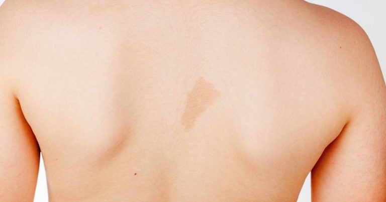 Cafe Au Lait Spots vết bớt da màu nâu nhạt